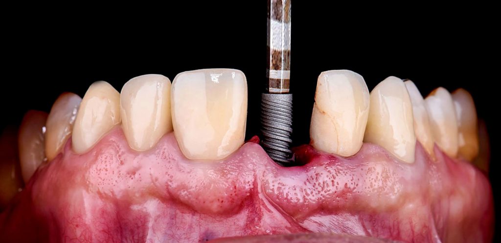 implantologie implant dentar satu mare clinica satu mare